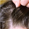 «Девочкам лучше не ходить с распущенными волосами»: специалисты рассказали, как красноярские дети заражаются вшами и гнидами