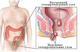 Геморроидальные узлы представляют собой мешотчатые расширения венозного сплетения, находящегося вокруг прямой кишки