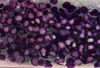 Клеточная картина при хроническом лимфолейкозе