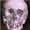 Хирурги красноярской БСМП восстановили мужчине лицо после серьезной редкой травмы