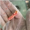 «Так внутри сосудов выглядят вкусняшки»: красноярский хирург показала гигантскую бляшку из сонной артерии пациента (видео) 