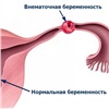 Красноярские врачи спасли женщину с двумя беременностями